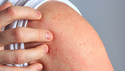 Як проявляється токсокароз у людини: симптоми, ознаки, фото